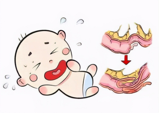 宝宝肠套叠应该如何治疗？如何预防？